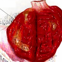 Gastrite Hemorrágica Com Úlceras